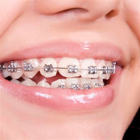 ventajas de brackets metálicos